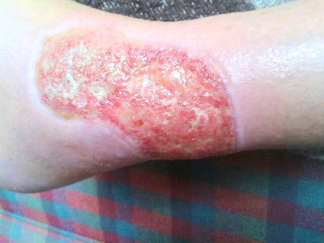 Cleaned outer Ulcer as presented